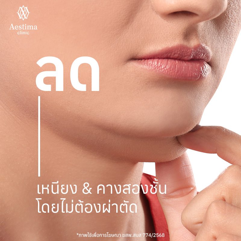 ลดเหนียงและคางสองชั้น โดยไม่ต้องผ่าตัด 1